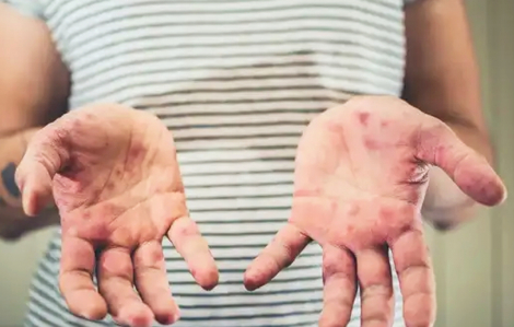 Thế giới có thể đã mất miễn dịch cộng đồng