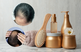 6 lưu ý về việc chăm sóc sau khi cấy tóc giống chồng hoa hậu H'Hen Niê