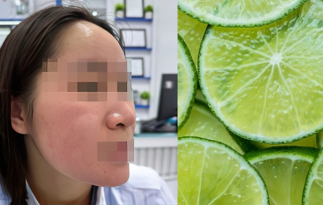 Trị mụn bằng nước cốt chanh, cô gái bị viêm da nặng