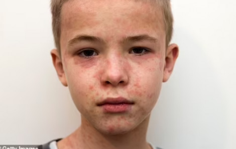 Hơn 1.000 ca mắc sởi tại Mỹ