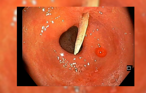 Cụ bà 79 tuổi bị xương cá đâm thủng dạ dày