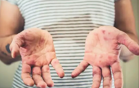 Thế giới có thể đã mất miễn dịch cộng đồng