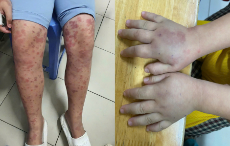 Liên tiếp nhiều trẻ mắc ban xuất huyết Schonlein- Henoch bị chẩn đoán nhầm