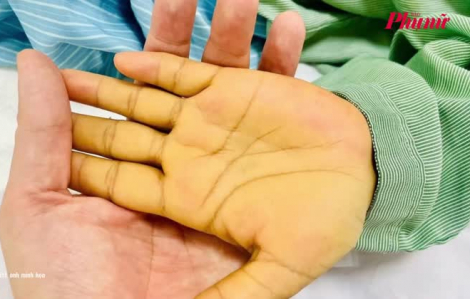 Tin tức ngày 14/5: Người phụ nữ hôn mê vì hàng tỉ virus viên gan B trong máu