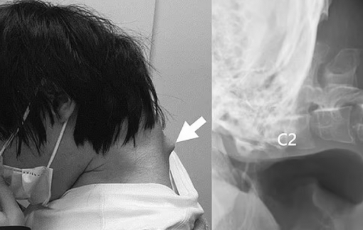 "Hội chứng đầu rụng" đáng sợ khi nhìn vào điện thoại quá nhiều