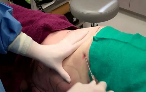 Bệnh nhân nữ suy tim sau hút mỡ bụng, Sở Y tế TPHCM vào cuộc