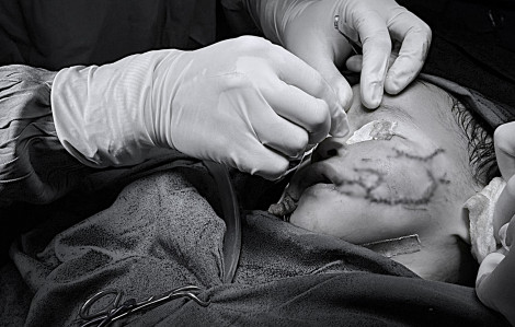 Bé 2 tuổi bị chó nhà cắn nham nhở vùng mặt