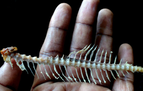 Liên tiếp bệnh nhân nhập viện vì xương cá đâm thủng nội tạng