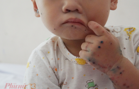 Việt Nam thử nghiệm vắc xin ngừa bệnh tay chân miệng, hiệu quả hơn 99%