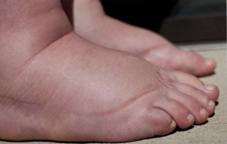 Hai anh em bỗng nhiên bị phù, đi khám mới biết mắc bệnh nguy hiểm