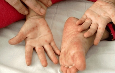 TPHCM: Số ca tay chân miệng tăng mạnh, một số trẻ diễn biến nặng