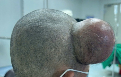 Phẫu thuật lấy khối u khổng lồ vùng thái dương cho một nam bệnh nhân