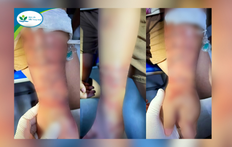 Bé gái 10 tuổi phải đi cấp cứu vì ôm sứa khi tắm biển