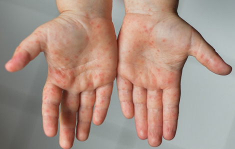 TPHCM: Ca tay chân miệng tiếp tục tăng mạnh