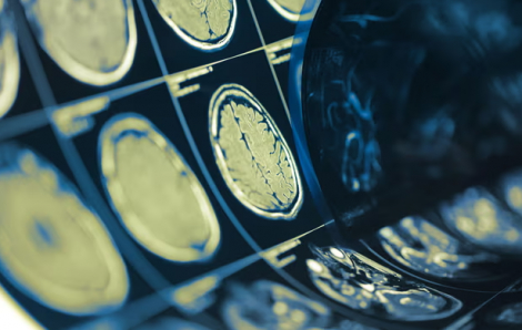 Thuốc miễn dịch làm giảm ung thư lan rộng được ca ngợi là "Món quà của cuộc sống"