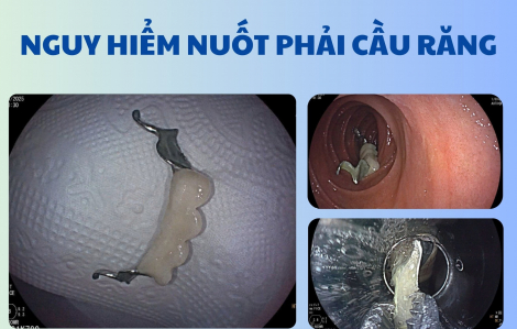 Cảnh báo: Nuốt cả cầu răng giả khi uống thuốc