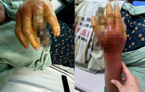 Người phụ nữ viêm hoại tử bàn tay sau khi bị gai cá đâm