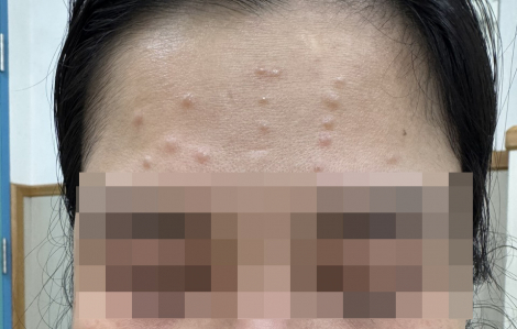 Spa kê corticoid liều cao, khách hàng đối mặt nguy cơ suy tuyến thượng thận
