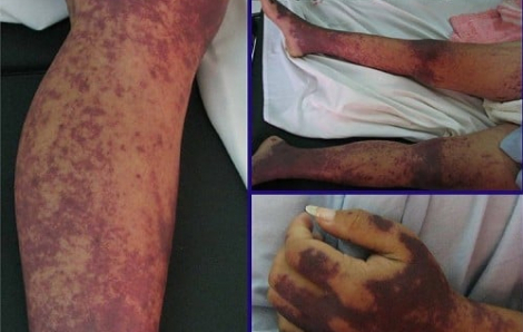 Cụ bà bán lòng lợn nhiễm liên cầu khuẩn