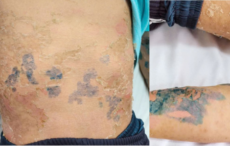 Đắp lá chữa sởi, nam sinh bị trợt loét toàn thân