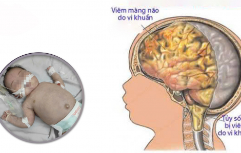 Bé sơ sinh 20 ngày tuổi bị viêm màng não mô cầu hiếm gặp