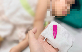 Bé gái 21 tháng nuốt kẹp tóc dài 5cm vào dạ dày