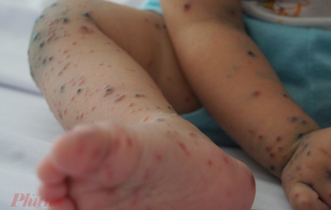 Làm gì để bảo vệ trẻ trước bệnh tay chân miệng?