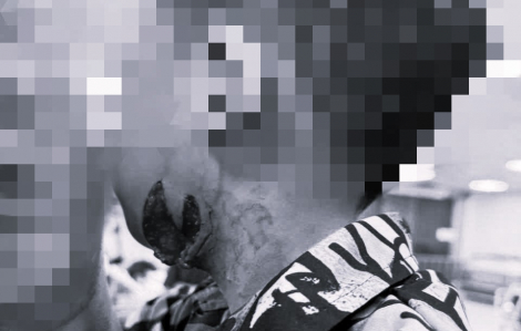 Về quê nghỉ hè, bé trai bị chó nhà hàng xóm cắn rách cổ