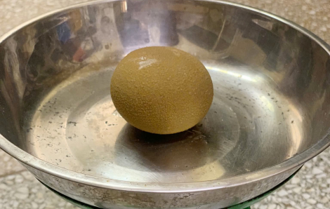 Bất ngờ sỏi bàng quang to như... quả trứng