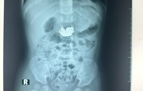 Bé 22 tháng tuổi cấp cứu vì nuốt nguyên cả sợi dây chuyền