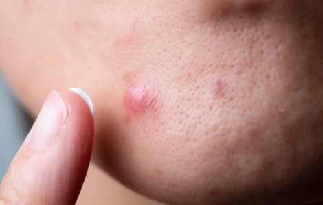 Thiếu nữ tử vong vì nguyên do không ngờ khi chăm sóc da