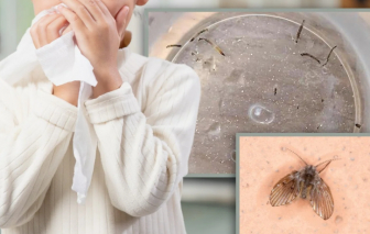 Bé gái 8 tuổi mỗi ngày đều nôn ra ấu trùng trong nhiều tháng