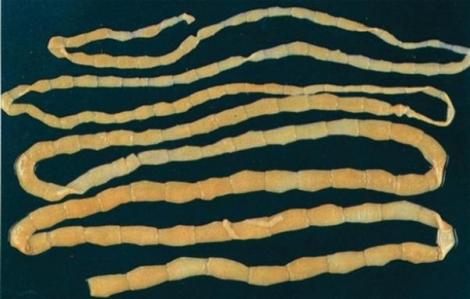 Tưởng rối loạn tiêu hóa, người đàn ông xổ ra sán dây dài hơn 3m