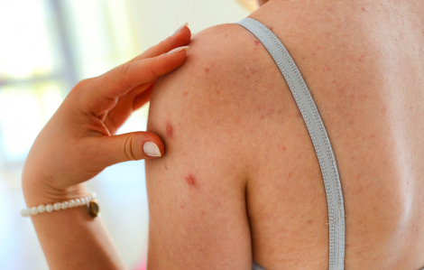 Cách điều trị mụn cơ thể và ngăn ngừa mụn vào mùa hè