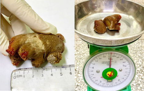 Đau bụng âm ỉ, bất ngờ phát hiện sỏi thận khổng lồ