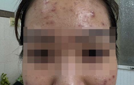 Mụn bùng phát dữ dội sau khi "giải độc gan"