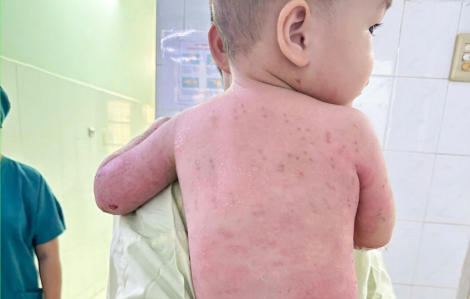 Bé trai 2 tuổi bị bỏng 60% phải ghép da từ mẹ ruột