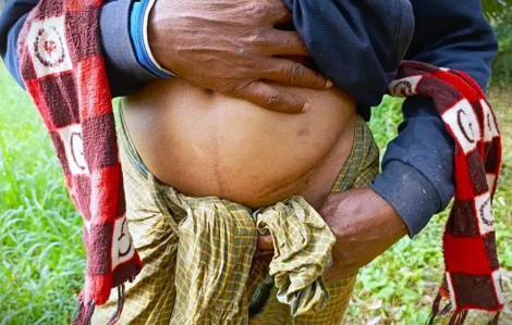 Bi kịch của “ngôi làng một quả thận”