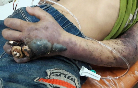Bị rắn cắn, người đàn ông nguy kịch vì đắp lá của thầy lang