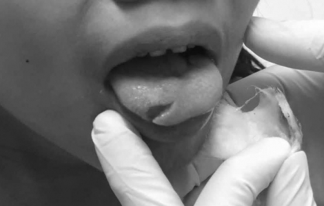 Bé gái nghịch kéo cắt phải lưỡi