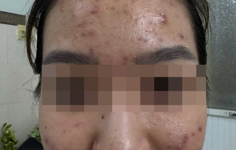 Mụn bùng phát dữ dội sau khi "giải độc gan"