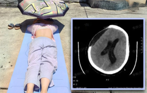 Cụ bà bị xuất huyết não, hôn mê sau khi tắm nắng để cải thiện sức khỏe