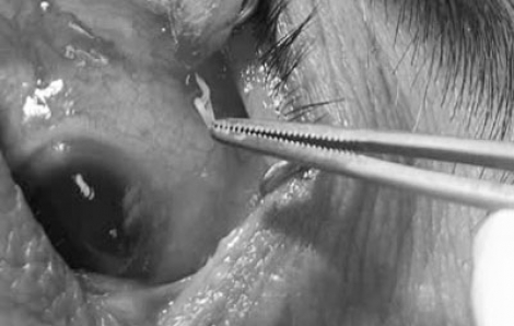 Cộm, đỏ mắt, người phụ nữ bất ngờ phát hiện con giun dài 4cm dưới kết mạc