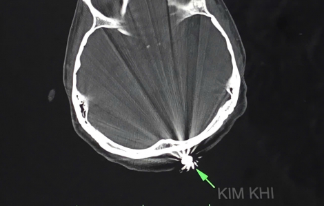 Cứu người phụ nữ bị đạn lạc găm vào đầu