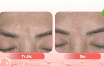 Lão hóa da sắc tố tuổi trung niên