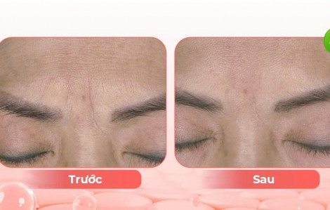 Lão hóa sắc tố da tuổi trung niên