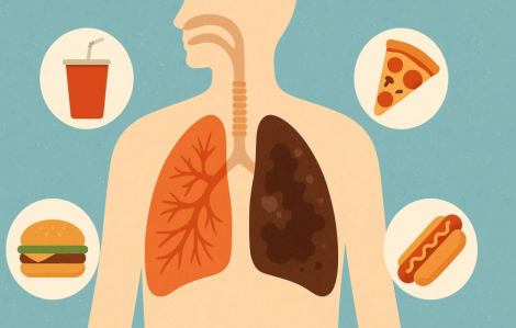 Thực phẩm siêu chế biến làm tăng nguy cơ ung thư phổi