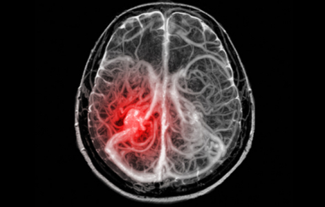 Ô nhiễm không khí liên quan đến nguy cơ xuất huyết não