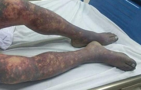 Hà Nội ghi nhận ca tử vong đầu tiên do mắc liên cầu lợn