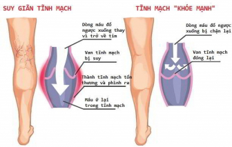 Tại sao suy giãn tĩnh mạch không được ngâm chân nước nóng?